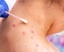 Mangaluru: Chickenpox rises among children in DK due to changing weather